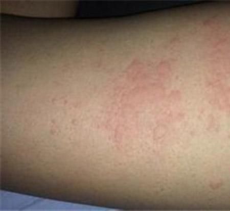 慢性荨麻疹的症状表现_急性荨麻疹和慢性荨麻疹的症状-第1张图片-