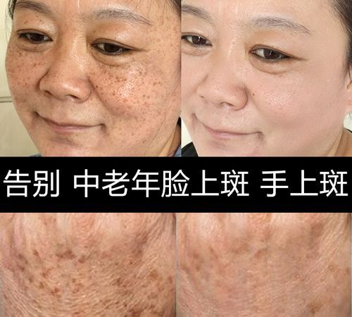 牛奶小苏打可以去斑吗