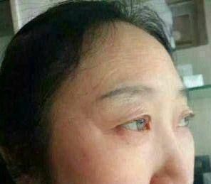 脸上长老人斑怎么办如何去除