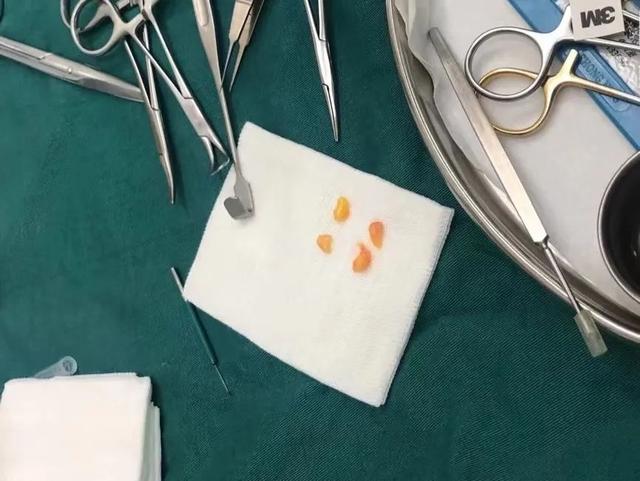 天然双眼皮和割过的双眼皮对比（看了100个双眼皮案例）(12)