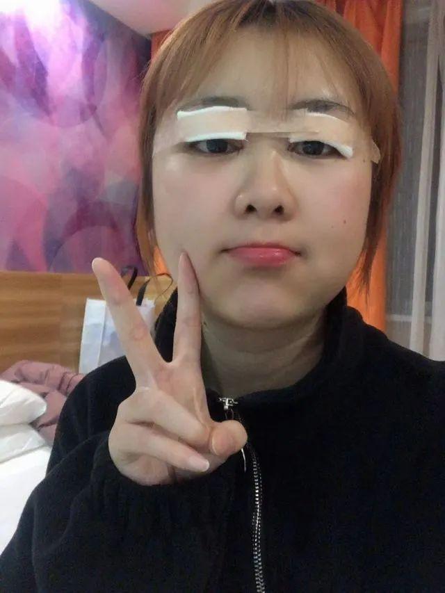天然双眼皮和割过的双眼皮对比（看了100个双眼皮案例）(17)