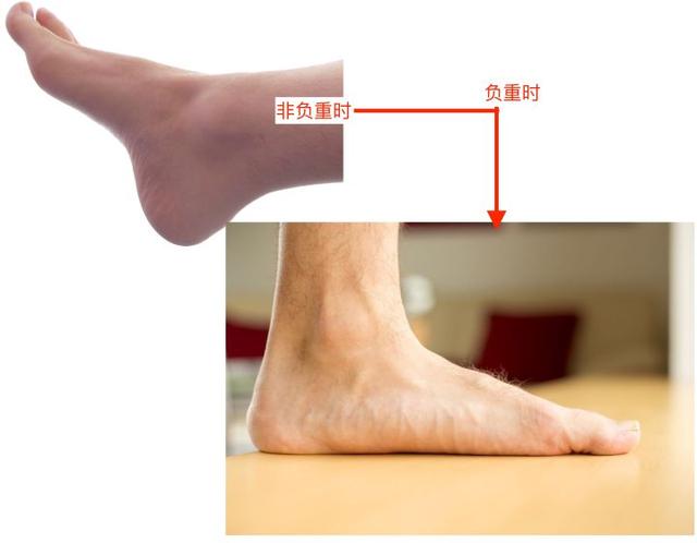 高平足和扁平足有什么区别（三分钟正视扁平足）(11)