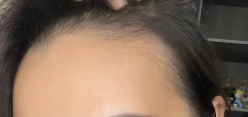 发际线怎么养回来 发际线怎么养回来