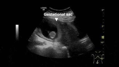 输卵管间质部妊娠(急腹症)