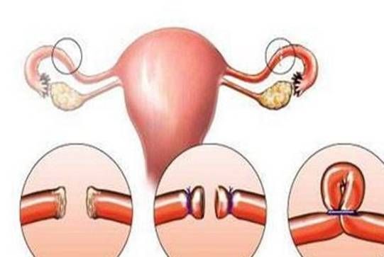 如果男人“结扎”,那“精子”会去哪里?别害羞,看完你就知道了